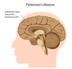 Parkinson's disease