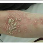 Homeopathic medicine for Psoriasis