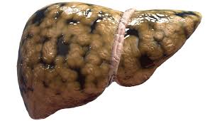 fatty liver