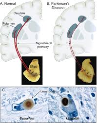 Parkinson's disease