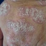 homeopathic medicine for psoriasis