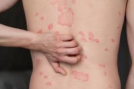 Homeopathic Medicine for Psoriasis