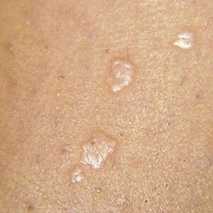 Skin Warts