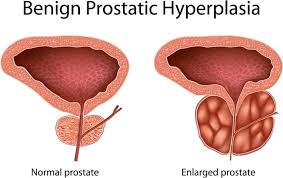 Homeopathic Medicine for Prostate Enlargement