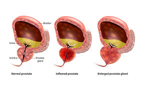 Homeopathic Medicine for Prostate Enlargement