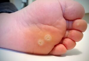 Skin Warts