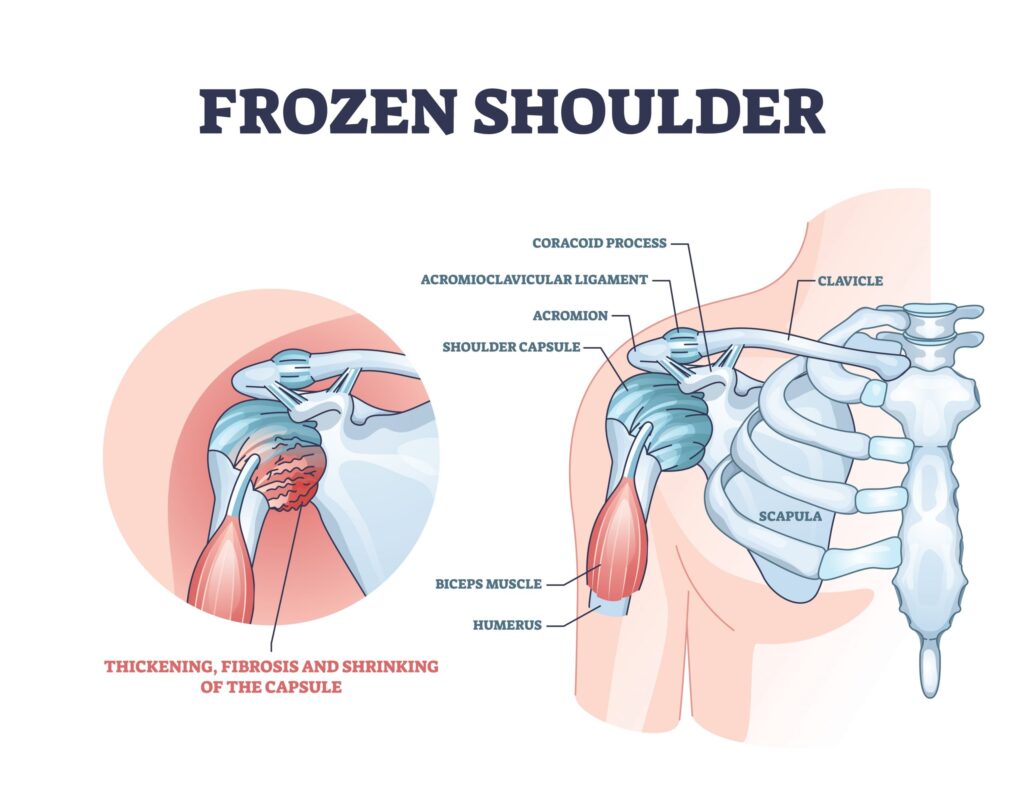 frozen shoulder homeopathic medicine