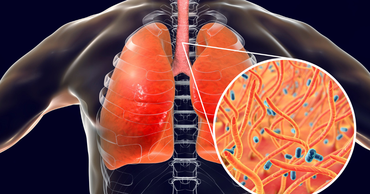 Cough Medicine in Homeopathy